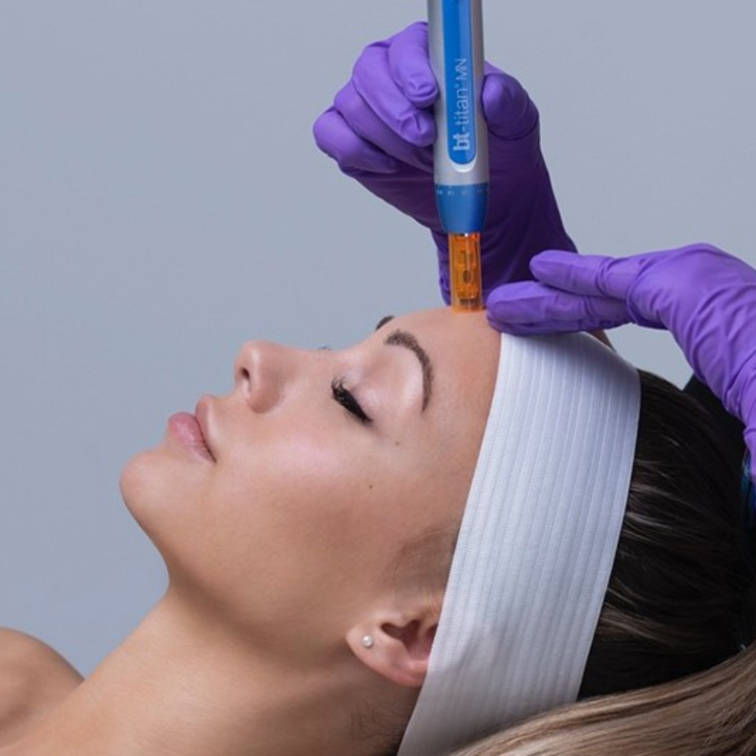 Microneedling