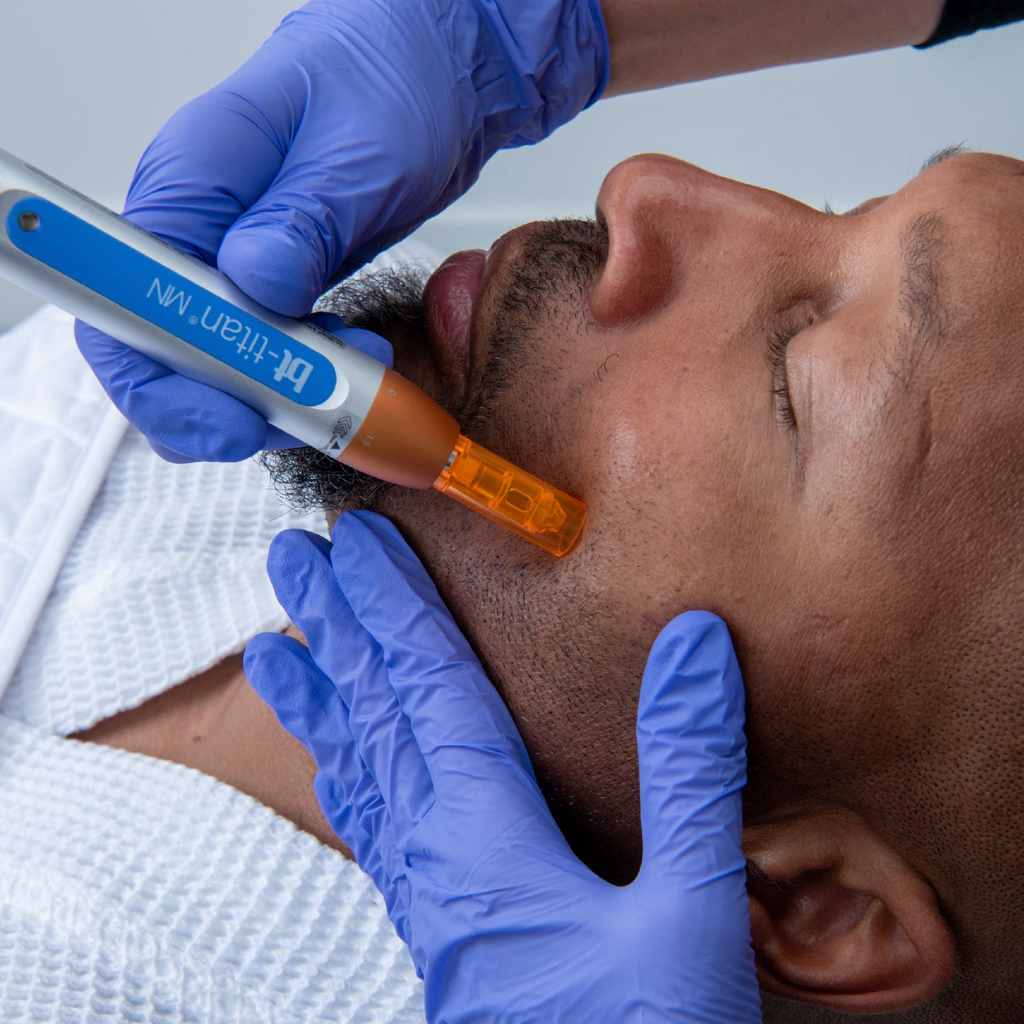 Bt- Titan "Microexfoliación"